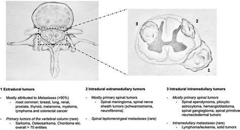 Frontiers | Establishing the Swiss Spinal Tumor Registry (Swiss-STR): a ...