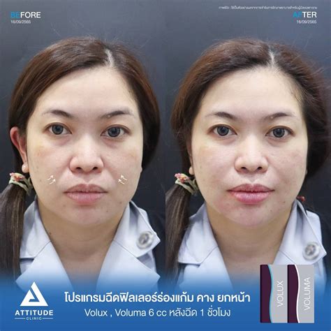 รีวิว Attitude Clinic ห้วยขวาง รีวิวโปรแกรมฉีดฟิลเลอร์ร่องแก้ม คาง ยก