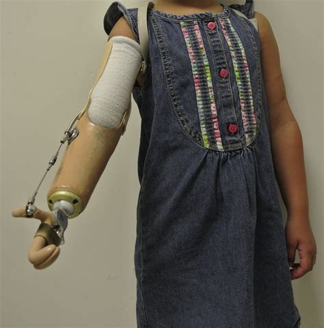 Pediatric Limb Differences And Amputations Physical Medicine And Rehabilitation Clinics