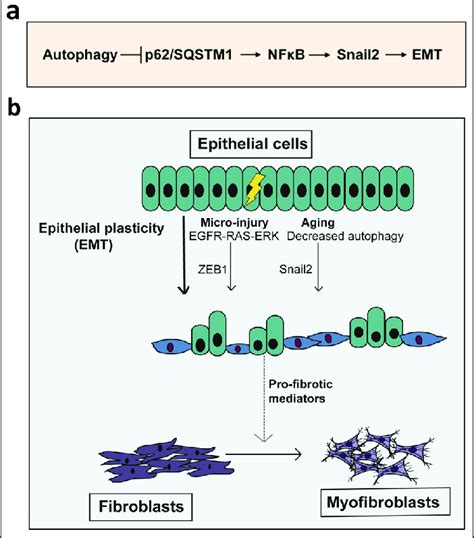 Autophagy Inhibition Mediated Epithelial Mesenchymal Transition