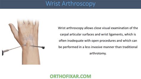 Wrist Arthroscopy • Easy Tutorial • Orthofixar 2024