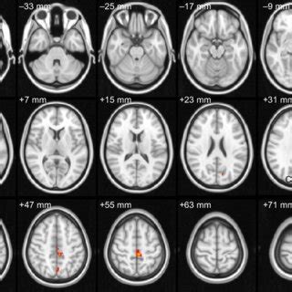 Spontaneous Brain Activity In The Ogi And Hc Groups Notes Significant