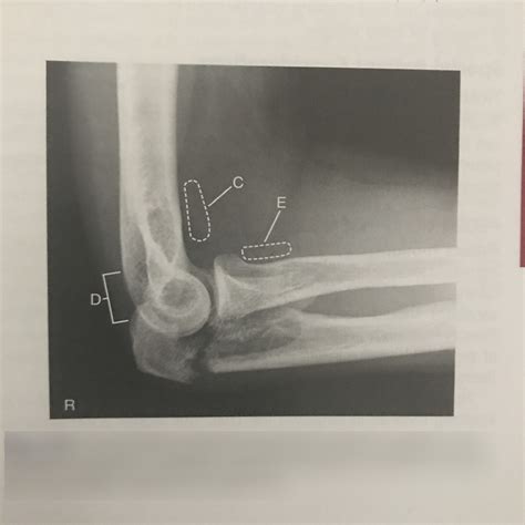 Lateral Elbow Fractured Olecranon Process Labeling Diagram Quizlet