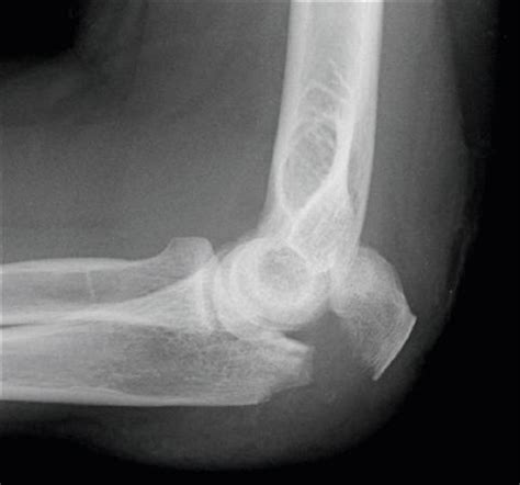 Olecranon Fractures Don T Forget The Bubbles