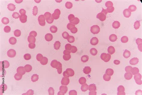 Blood Smear Show Rouleaux Formation For Complete Blood Count Stock