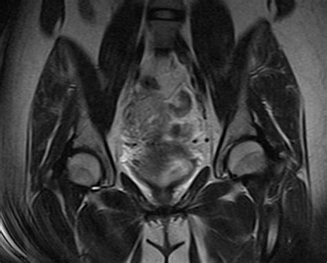 Tubal Ectopic Pregnancy Mri Image