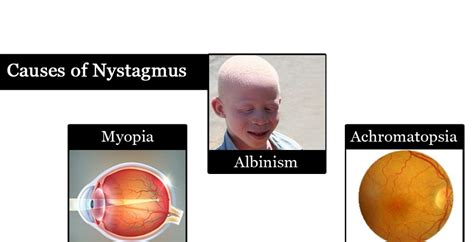 Pathological causes of nystagmus | Science online