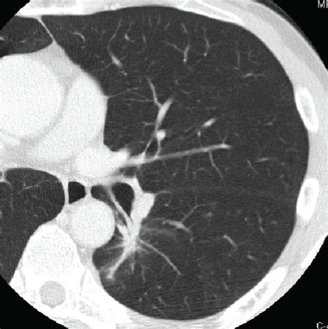 Chest CT Scan Chest CT Scan Performed On Admission A B Four Months