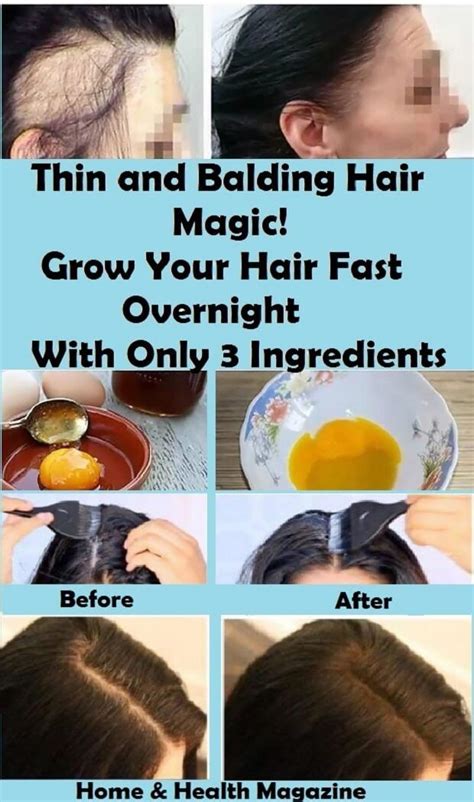 Grow Hair On Bald Spots Naturally Tips And Remedies The 2023 Guide To