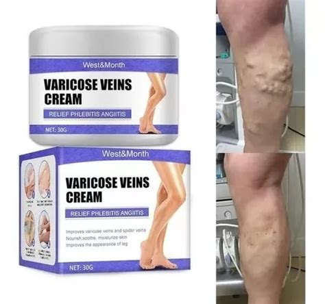 Creme Para Diminuir As Varizes Vasinhos Varicose Alivio Dor Mercadolivre