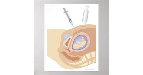 Amniocentesis Procedure Poster | Zazzle