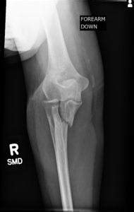 Elbow Fracture Diagnosis Treatments Reno Orthopedic Center