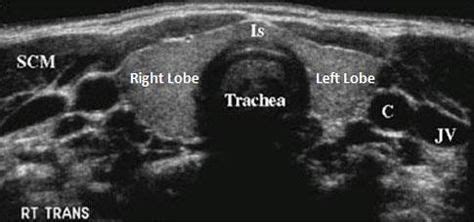 40+ Best Thyroid images in 2020 | thyroid, ultrasound, sonography