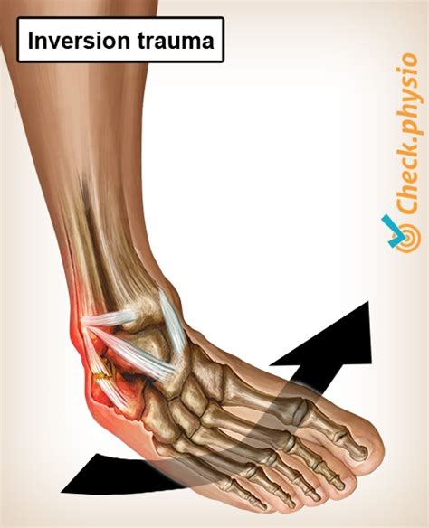 Lateral Ankle Ligament Injury Physio Check