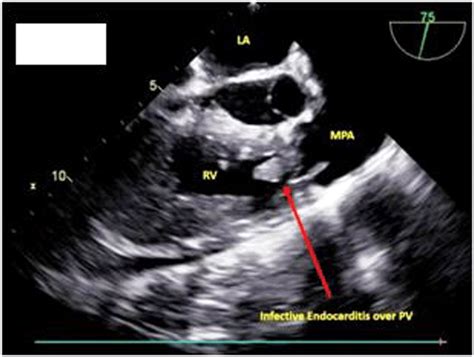 Twodimensional Echocardiogram Showing A Pedunculated Echogenic Mass