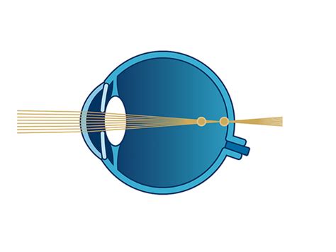 Hornhautverkrümmung Astigmatismus Lasern Symptome Ursachen