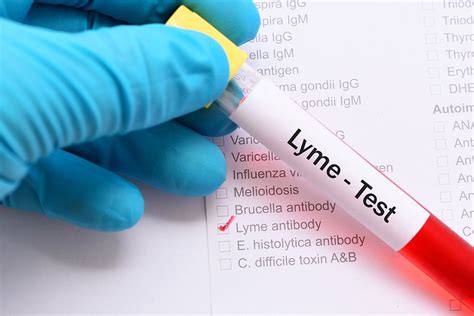 Tests For Lyme Disease New Research Aims To Improve Lyme Disease