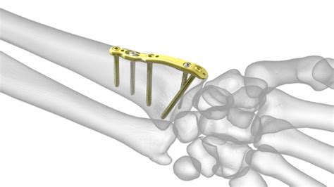 Acu Loc 2 Wrist Plating System Acumed