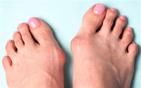 Non Surgical Bunion Treatments Everything You Want To Know