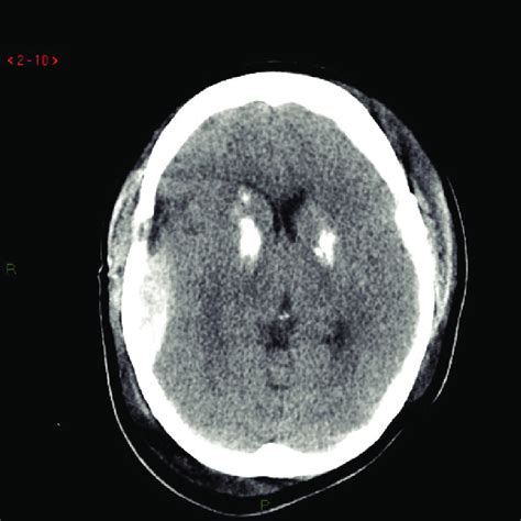 Ct Brain Scan Showing A Bilateral Gangliobasalhemorraghe And A Right