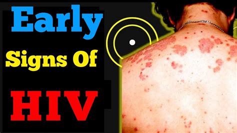 Recognizing Early Signs Of HIV In Men Early Symptoms Of HIV YouTube