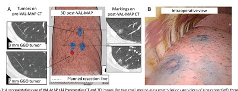 Figure 1 From Virtual Assisted Lung Mapping Outcome Of 100 Consecutive