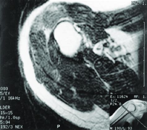 Axial Fse T2 Weighted Image Tr 4000 Te 85 Ef Demonstrates High