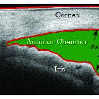 Anterior chamber imaging showing Schwalbe's line and yellow bounding ...