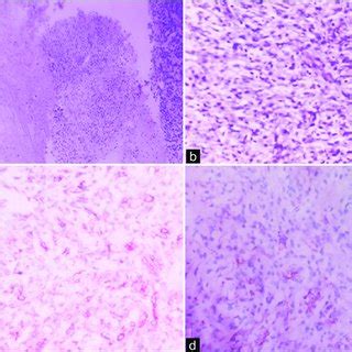 A Microphotograph Of Sheets Of Atypical Spindleshaped Cells In A