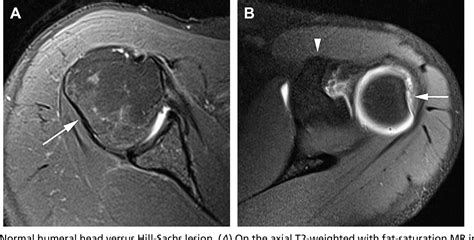 Abnormal Mri Left Shoulder