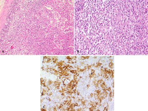 Langerhans Cell Histiocytosis A Andb Infiltration Of Lymphocyte Plasma