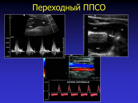 Ультразвуковая диагностика хирургических заболеваний сонных артерий ...