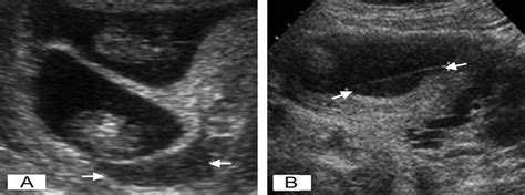 Ultrasound-Detected Subchorionic Hemorrhage and the Obstetri... : Obstetrics & Gynecology