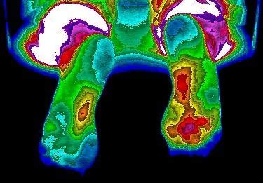 Using Infrared Imaging Before And After Shows Firefly Light Therapy