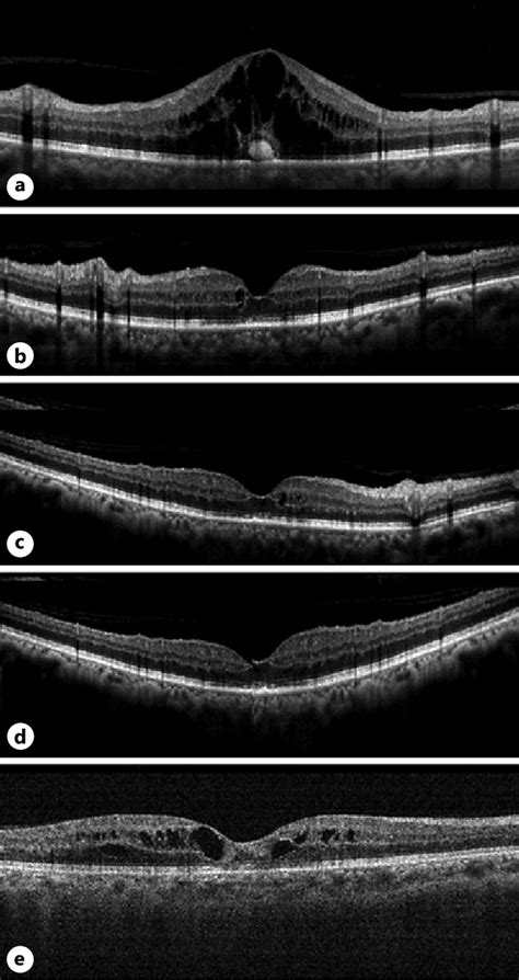 Case 2 A Spectral Domain Optical Coherence Tomography Sd Oct Image