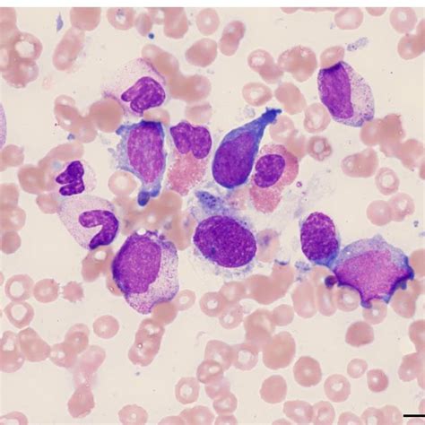 Hematoxylin And Eosin Staining Of Bone Marrow Aspirate Showing