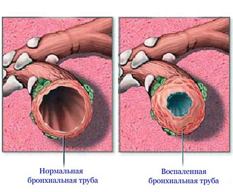Хронический бронхит, «бронхит курильщика», эмфизема легких