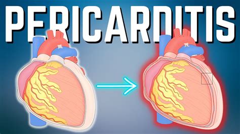 Pericarditis Aguda Explicada Claramente YouTube