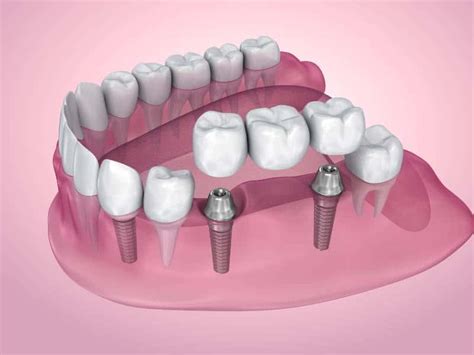 Implant Supported Bridges Texas Implant And Dental Center Of Amarillo