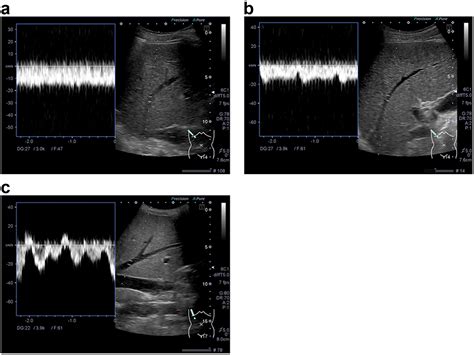 Liver Stiffness A Significant Relationship With The Waveform Pattern In The Hepatic Vein