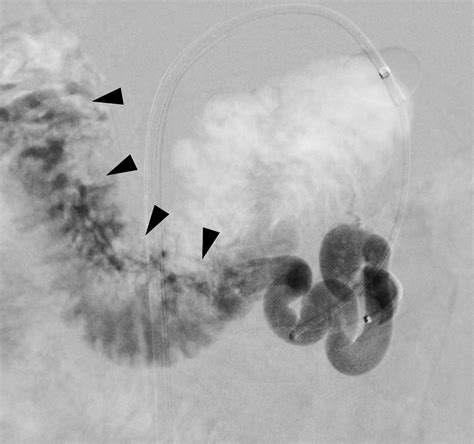 Retrograde N Butyl Cyanoacrylate Embolization Of Massive Bleeding From