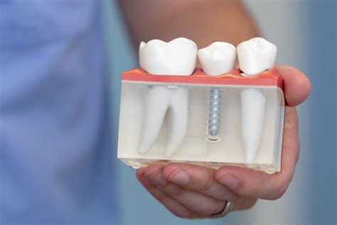 Teeth4You Implant Center Dental Implants Middletown NY