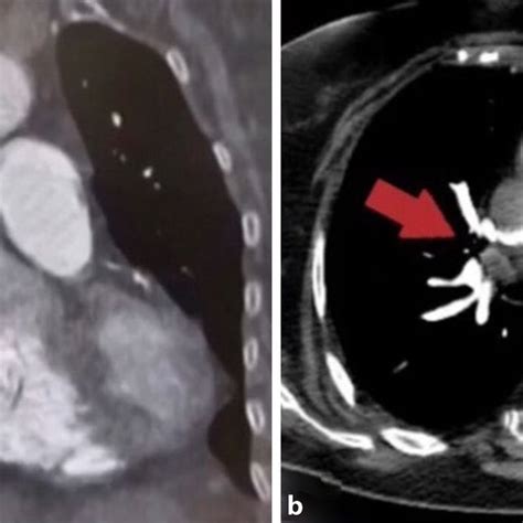 A Ct Pulmonary Angiography Ctpa Sagittal View Depicting The