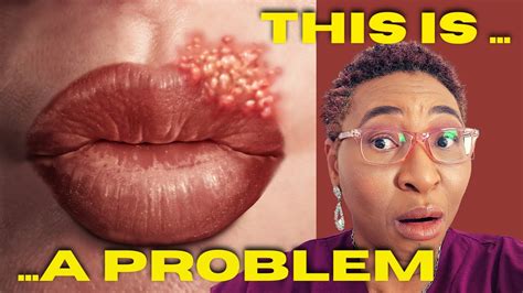 Cold Sore Every Time I Kiss Problem Explained Youtube