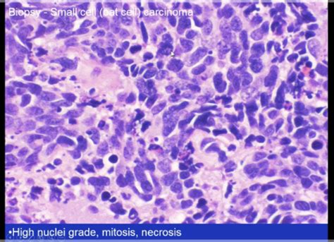 Lung Cancer Flashcards Quizlet