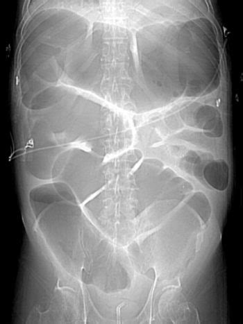 Toxic Megacolon – Undergraduate Diagnostic Imaging Fundamentals