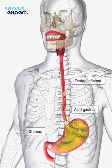 ESOFAGITA DE REFLUX Simptome și Tratament Servus Expert Med Reflux