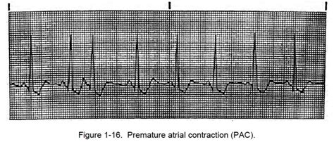 1 08 Atrial Rhythms Cardiac Rhythm Interpretation