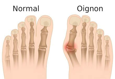 Oignon Et Douleur Au Gros Orteil Hallux Abducto Valgus Probl Mes De