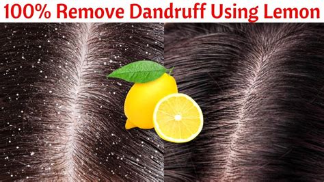 How To Use Lemon To Remove Dandruff In Just Day Get Rid Of Dandruff